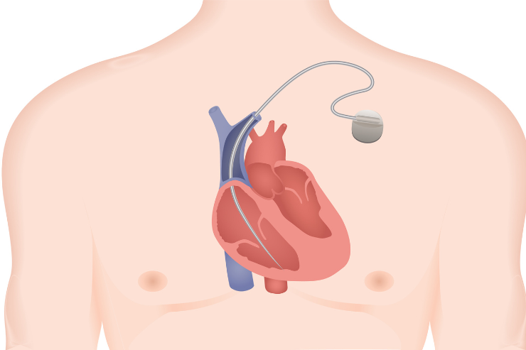 Cardiac Implantable Electronic Devices