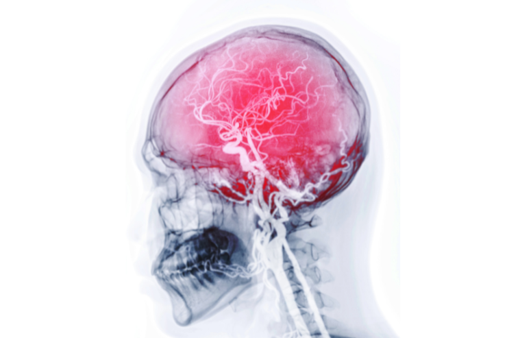 Carotid Angiography