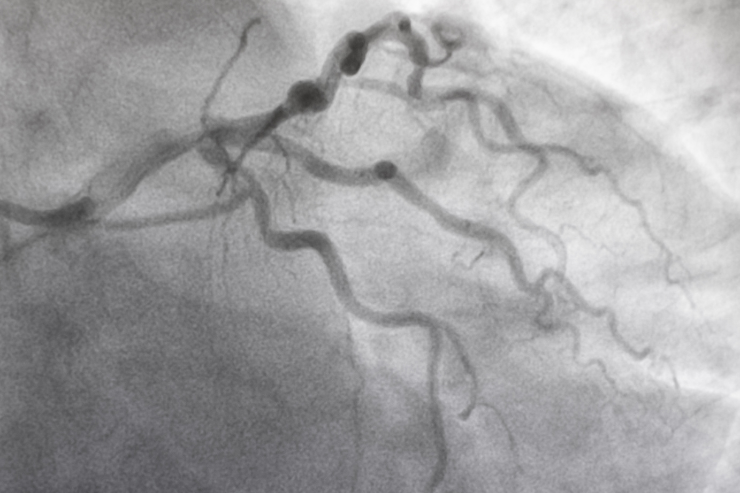 Coronary Angiography