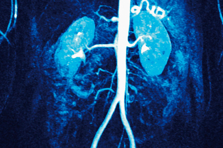 Renal Angiography