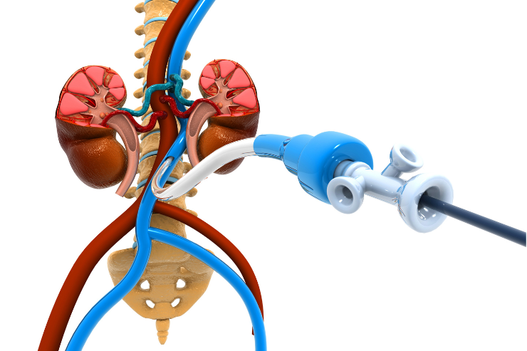 Renal Angioplasty