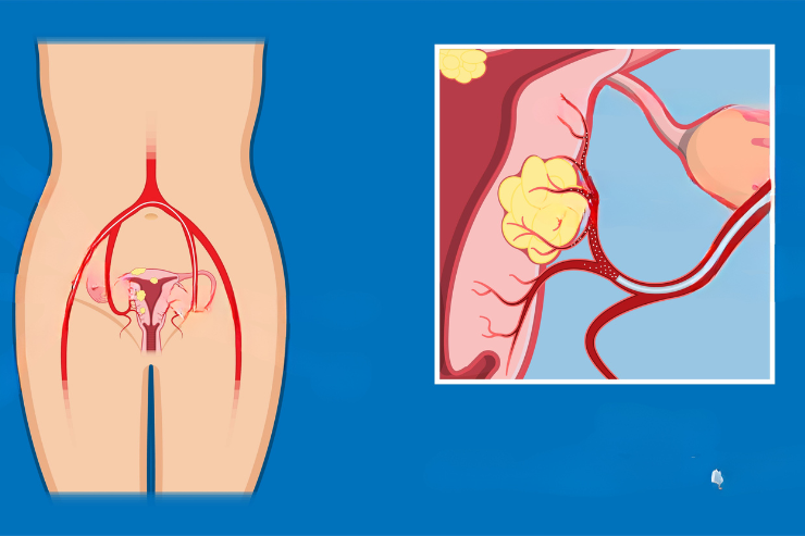Uterine Artery Embolization